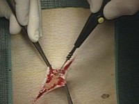 Un elettrobisturi in azione