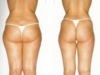 Effetto dimagrimento al Centro Blu Marine di Senigallia