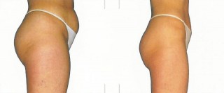 Effetto dimagrimento al Centro Blu Marine di Senigallia