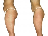 Dimagrimento al centro Blumarine di Senigallia